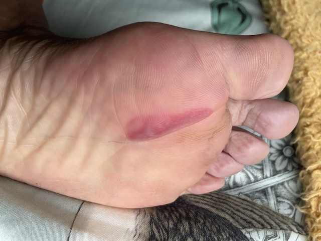 The sole of my foot with a big red angry mark on it