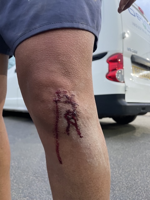 Blood trickling down from my knee